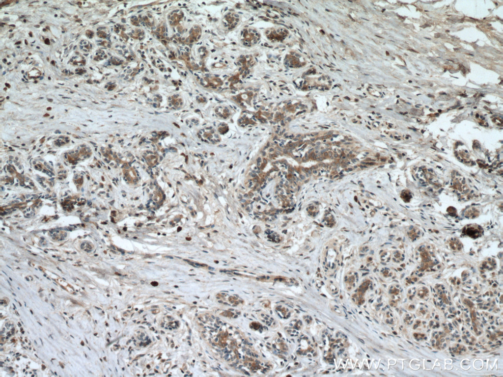 IHC staining of human breast cancer using 17076-1-AP