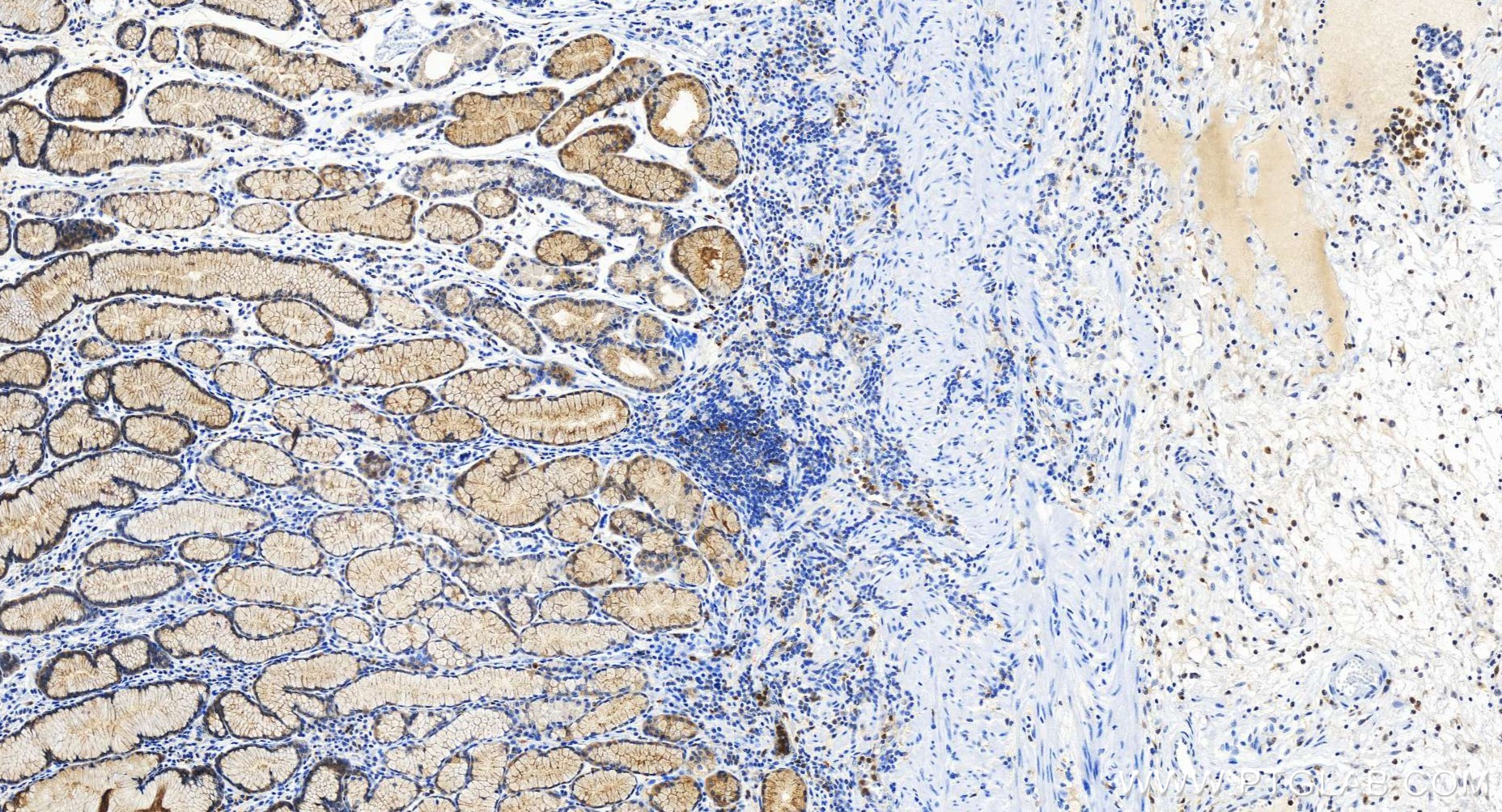 IHC staining of human stomach cancer using 84953-4-RR