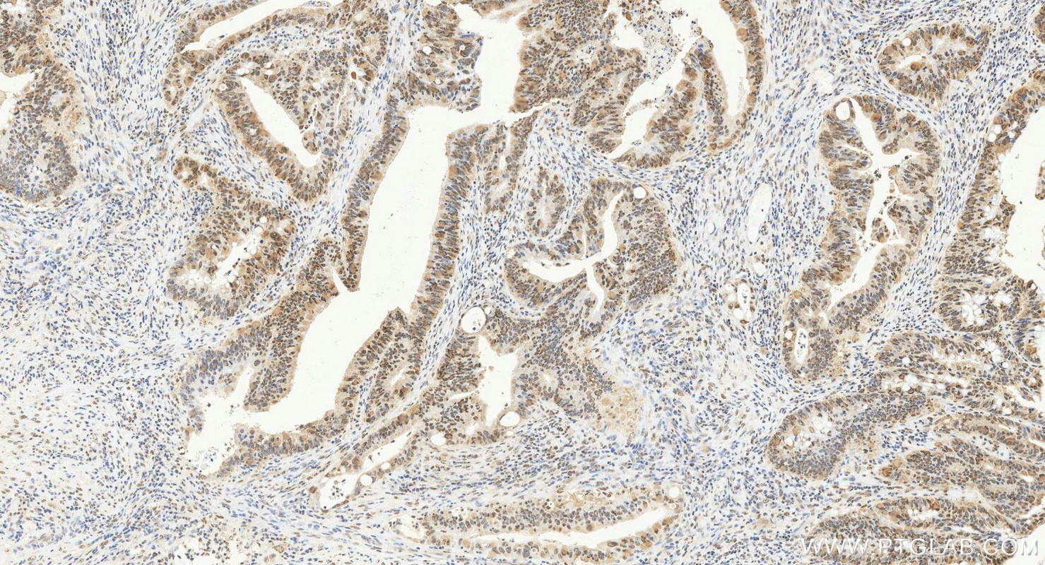 IHC staining of human colon cancer using 14206-1-AP
