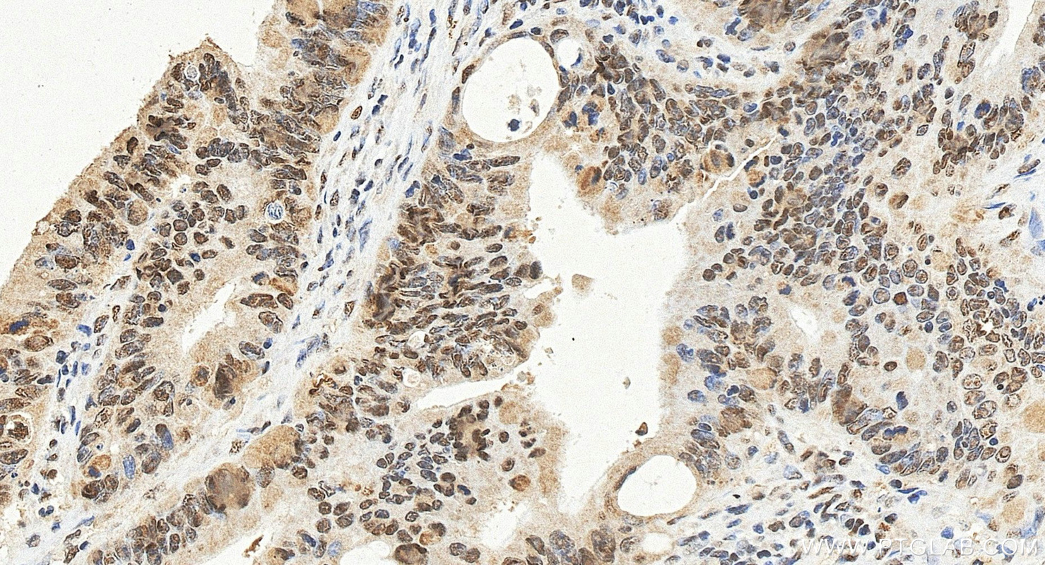 IHC staining of human colon cancer using 14206-1-AP