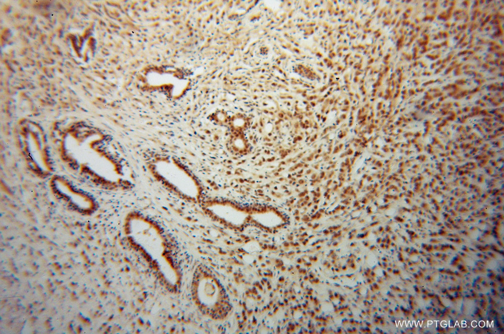 IHC staining of human prostate cancer using 14206-1-AP