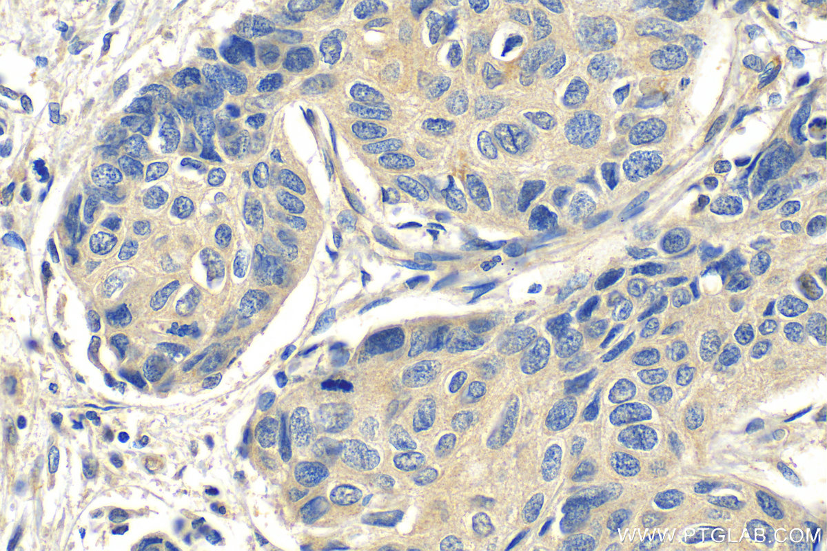IHC staining of human lung cancer using 19521-1-AP