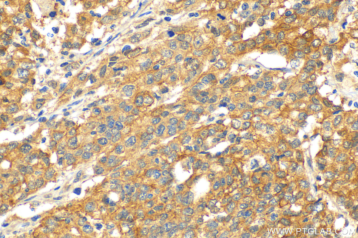 IHC staining of human stomach cancer using 19521-1-AP