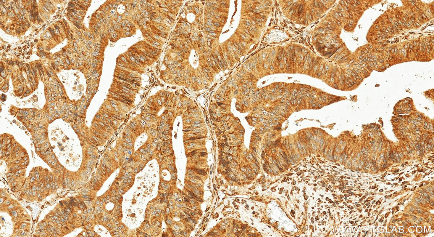 IHC staining of human colon cancer using 55279-1-AP