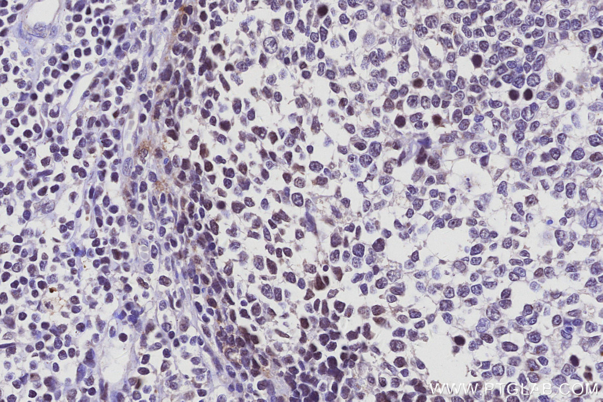 IHC staining of human tonsillitis using 17532-1-AP IHC staining of human tonsillitis using 17532-1-AP
