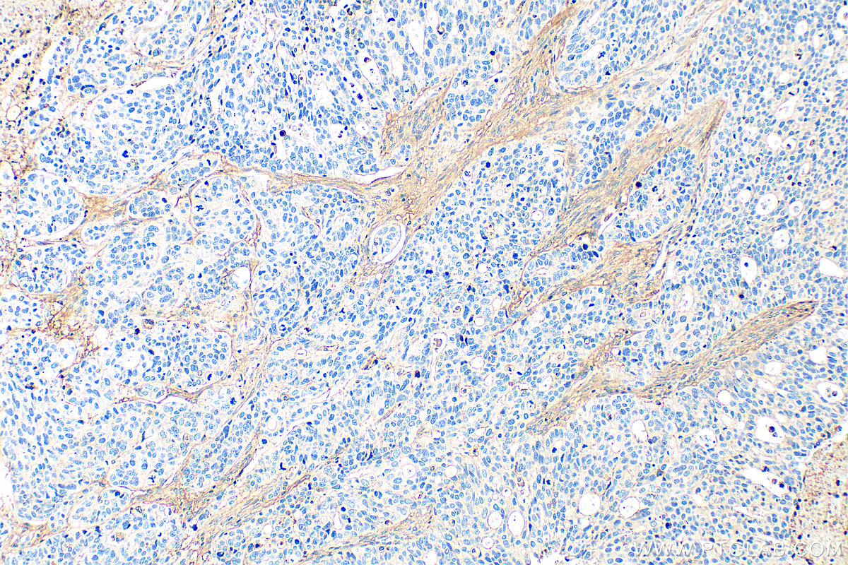 Immunohistochemical analysis of paraffin-embedded human ovary tumor tissue slide using 25474-1-AP (CTGF antibody) at dilution of 1:400 (under 10x lens). Heat mediated antigen retrieval with Tris-EDTA buffer (pH 9.0). IHC staining of human ovary tumor using 25474-1-AP