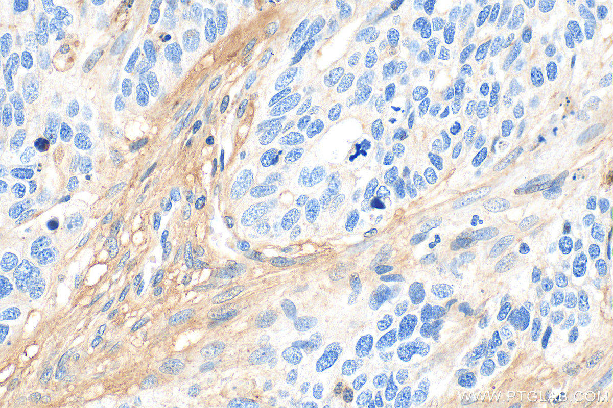 Immunohistochemical analysis of paraffin-embedded human ovary tumor tissue slide using 25474-1-AP (CTGF antibody) at dilution of 1:400 (under 40x lens). Heat mediated antigen retrieval with Tris-EDTA buffer (pH 9.0). IHC staining of human ovary tumor using 25474-1-AP