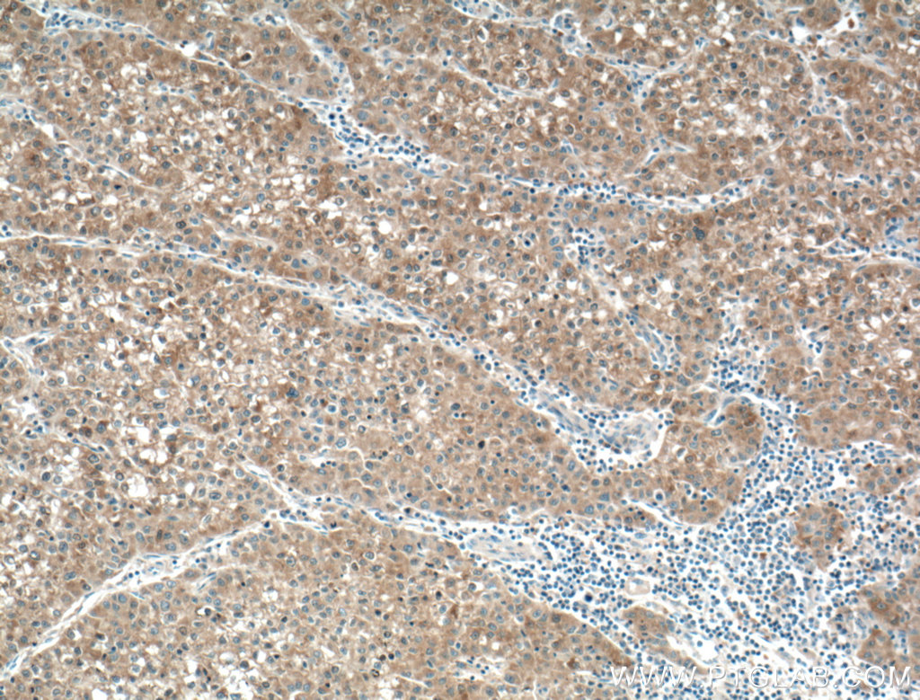 IHC staining of human liver cancer using 12217-1-AP