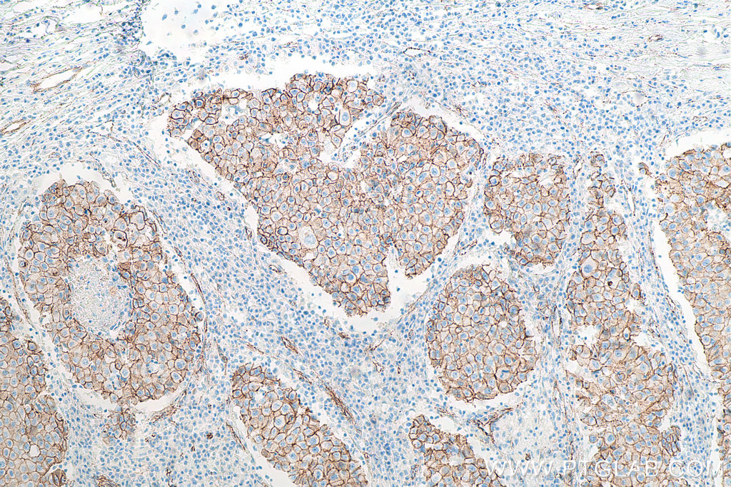IHC staining of human breast cancer using 66379-1-Ig IHC staining of human breast cancer using 66379-1-Ig