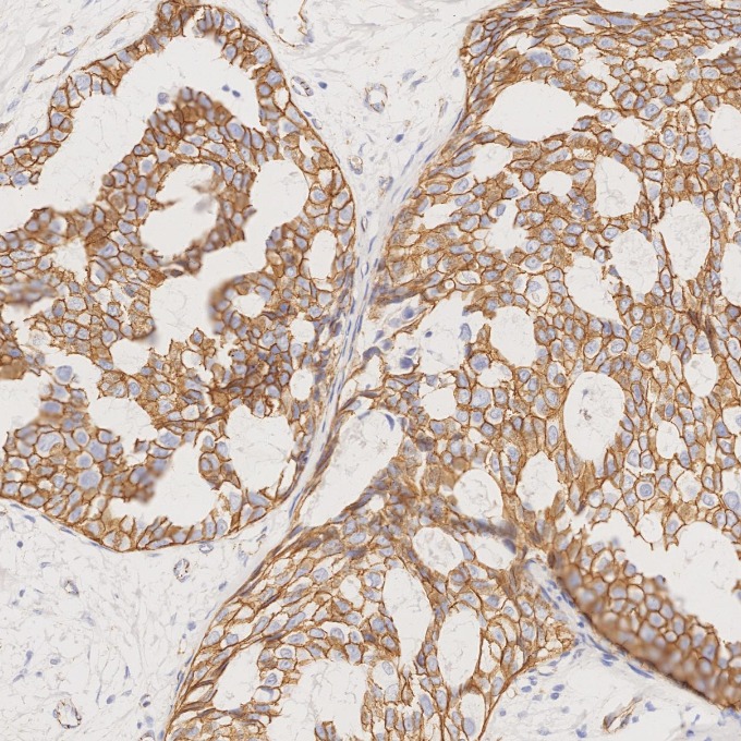 IHC staining of human breast cancer using 66379-1-Ig