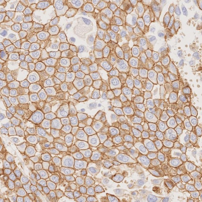 IHC staining of human liver cancer using 66379-1-Ig