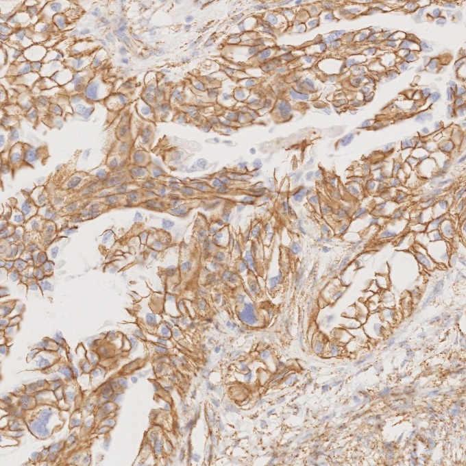 IHC staining of human ovary cancer using 66379-1-Ig