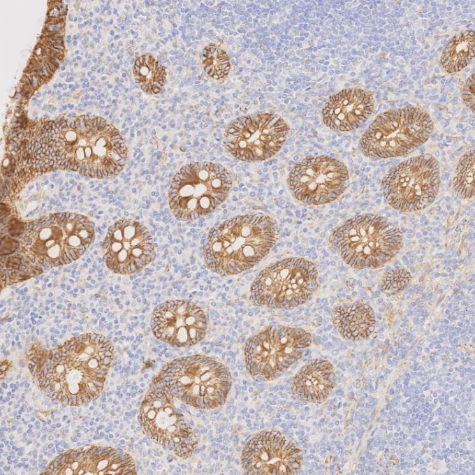 IHC staining of human appendicitis using 66379-1-Ig