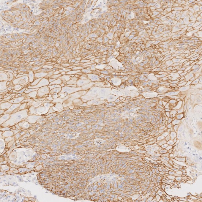 IHC staining of human cervical cancer using 66379-1-Ig