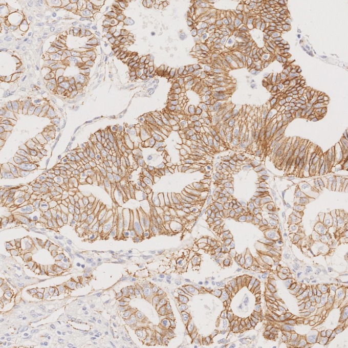 IHC staining of human pancreas cancer using 66379-1-Ig