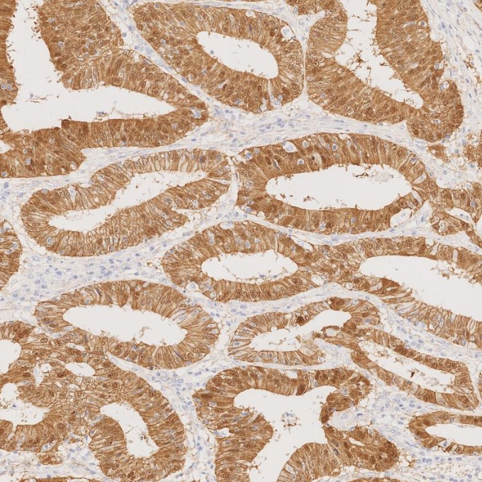 IHC staining of human colorectal cancer using 66379-1-Ig