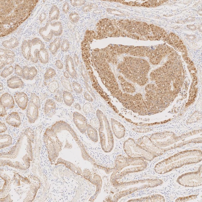IHC staining of human stomach cancer using 66379-1-Ig