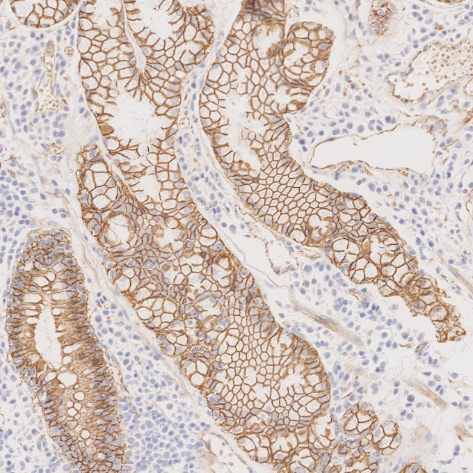 IHC staining of human stomach cancer using 66379-1-Ig