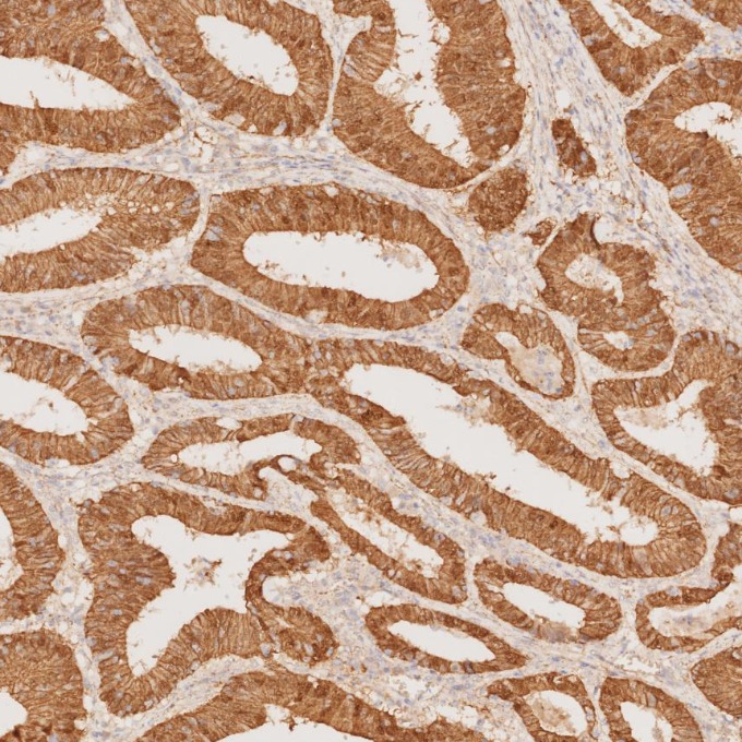IHC staining of human colorectal cancer using 66379-1-Ig