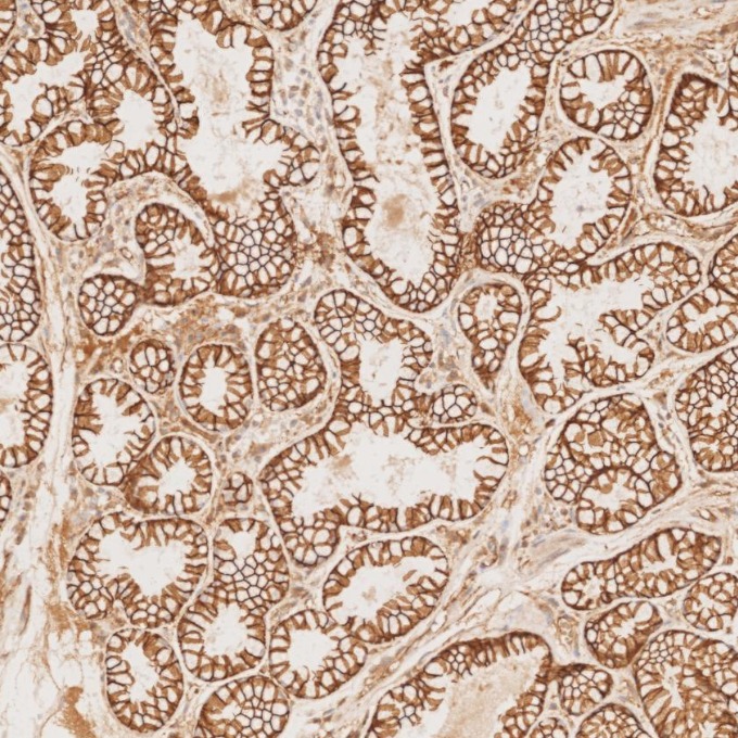 IHC staining of human stomach cancer using 66379-1-Ig