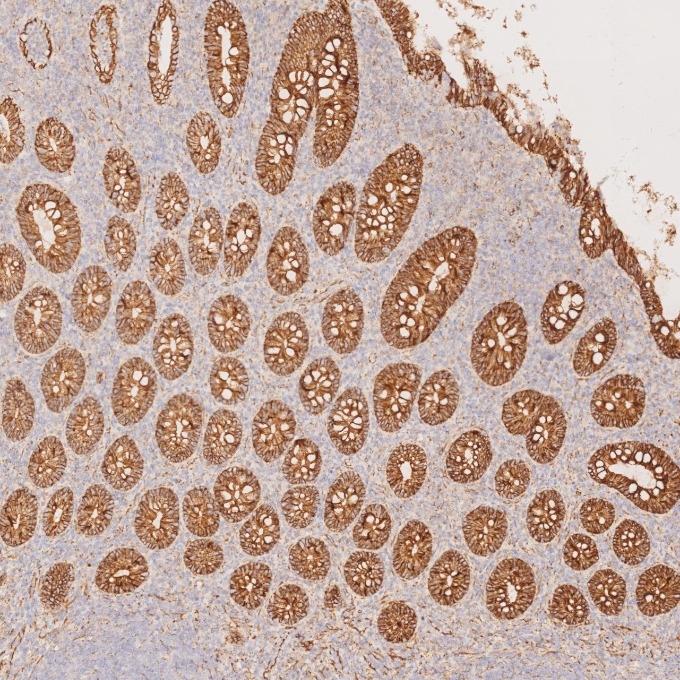 IHC staining of human appendicitis using 66379-1-Ig