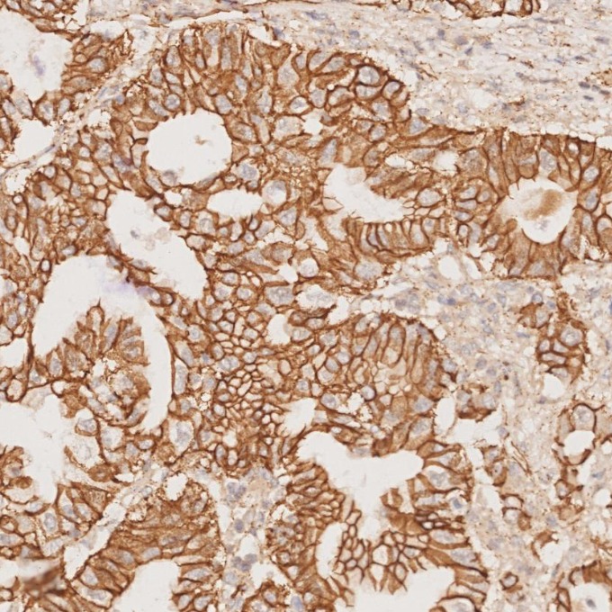 IHC staining of human pancreas cancer using 66379-1-Ig