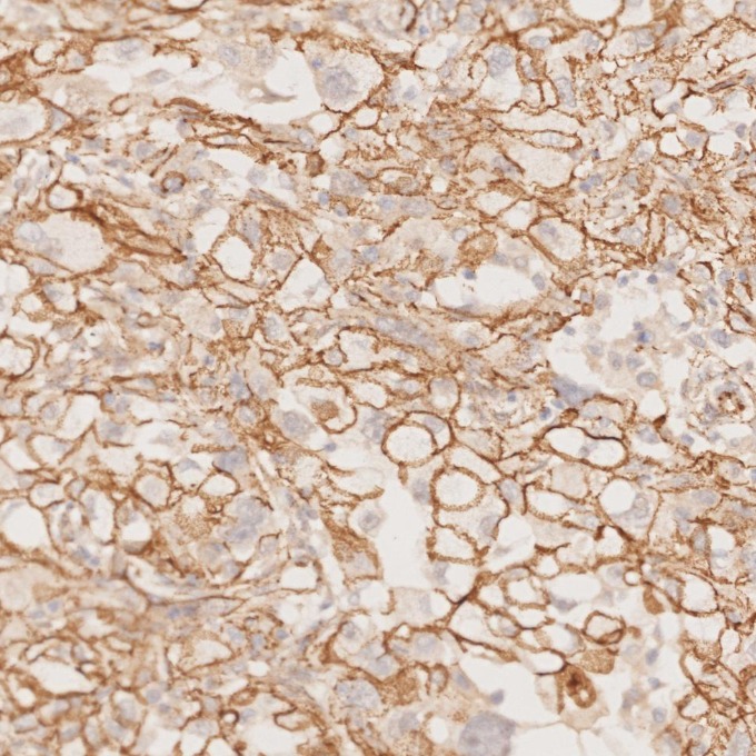 IHC staining of human ovary cancer using 66379-1-Ig