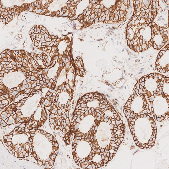 IHC staining of human breast cancer using 66379-1-Ig