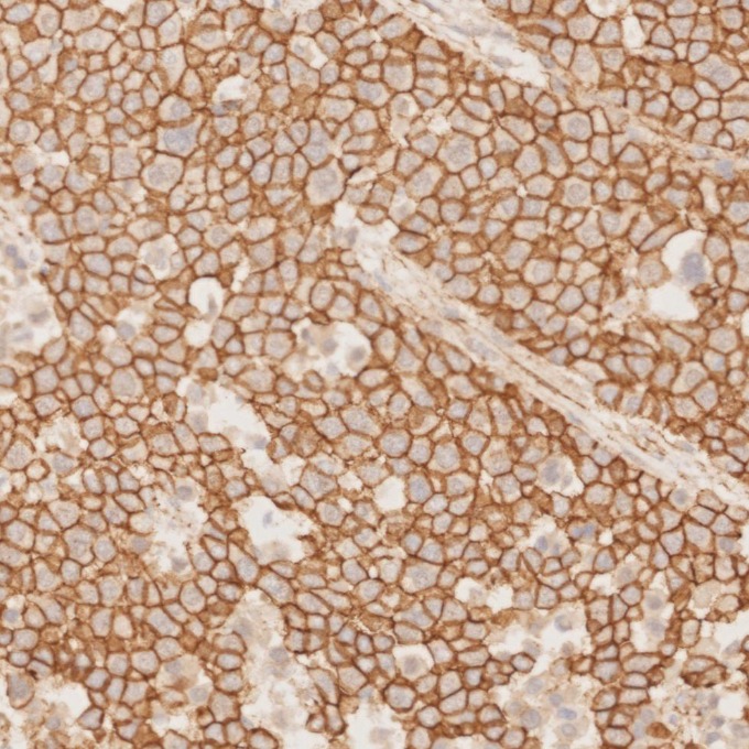 IHC staining of human liver cancer using 66379-1-Ig