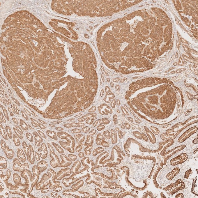 IHC staining of human stomach cancer using 66379-1-Ig