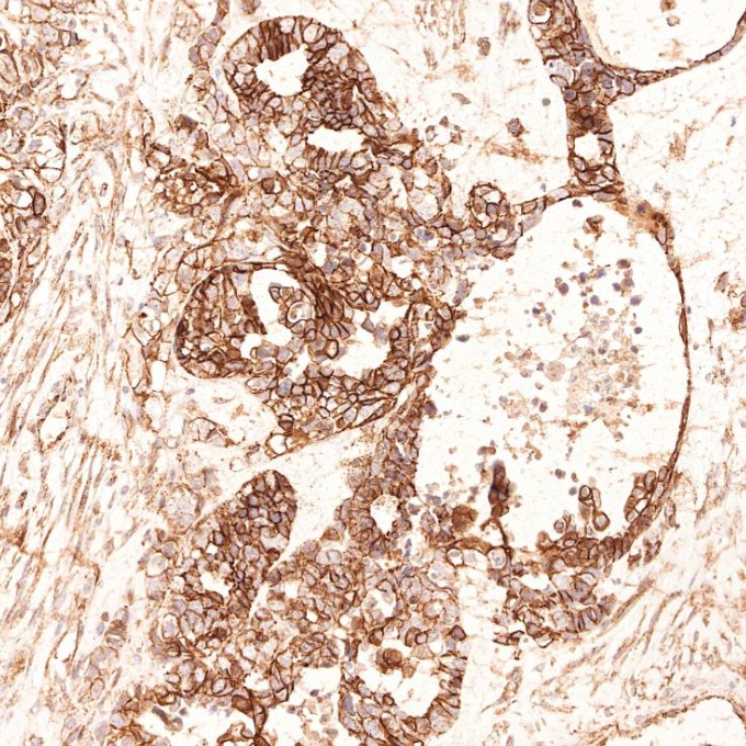 IHC staining of human ovary cancer using 66379-1-Ig