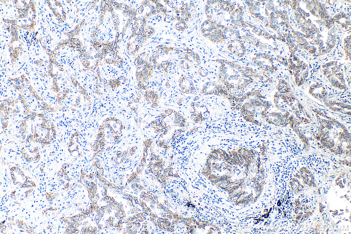 IHC staining of human lung cancer using 12180-1-AP