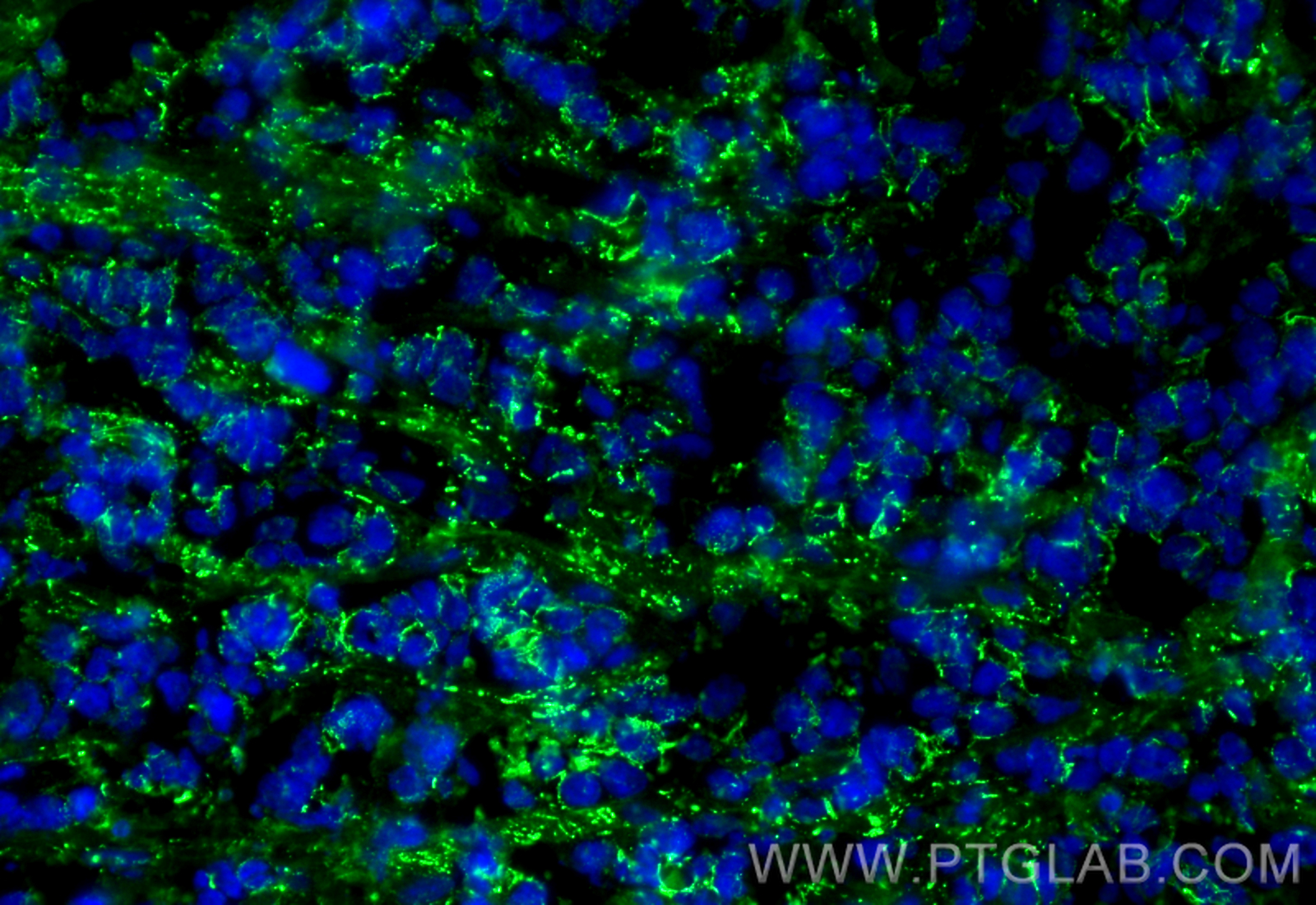 IF Staining of mouse breast cancer using 66208-1-Ig