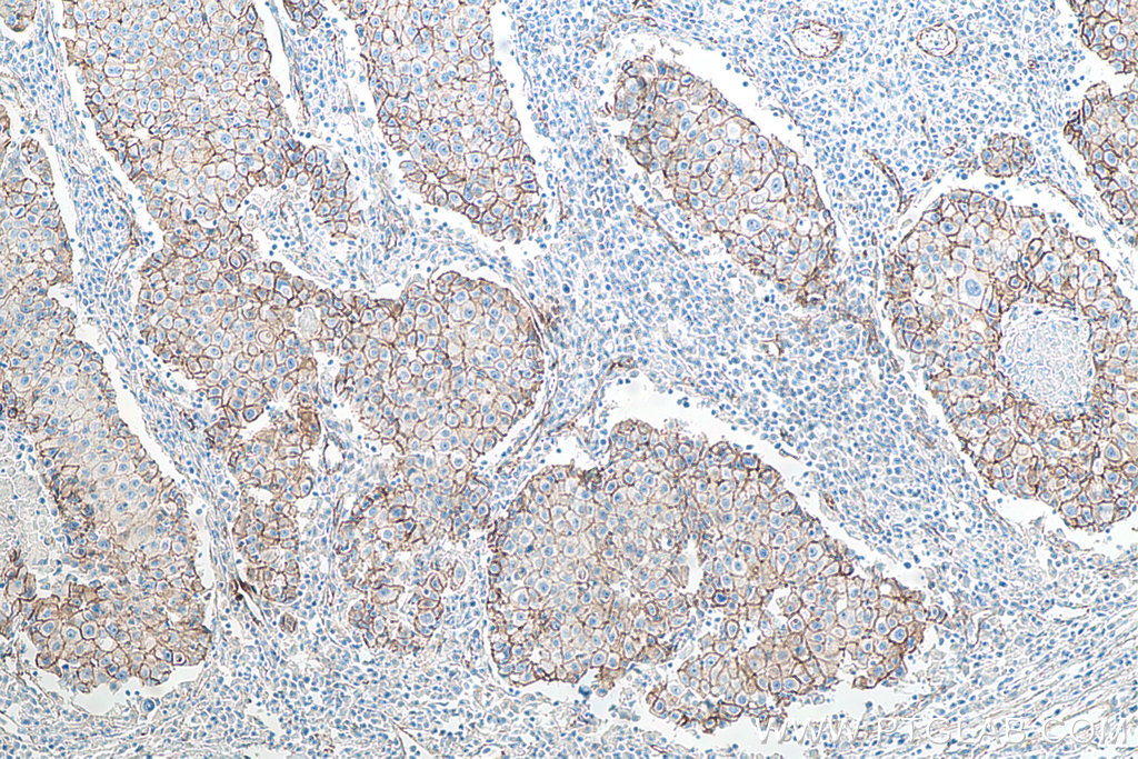 IHC staining of human breast cancer using 66208-1-Ig IHC staining of human breast cancer using 66208-1-Ig