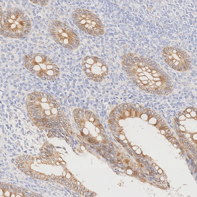 IHC staining of human appendicitis using 66208-1-Ig IHC staining of human appendicitis using 66208-1-Ig