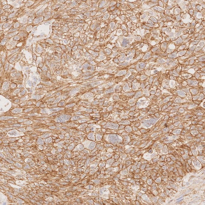 IHC staining of human ovary cancer using 66208-1-Ig IHC staining of human ovary cancer using 66208-1-Ig