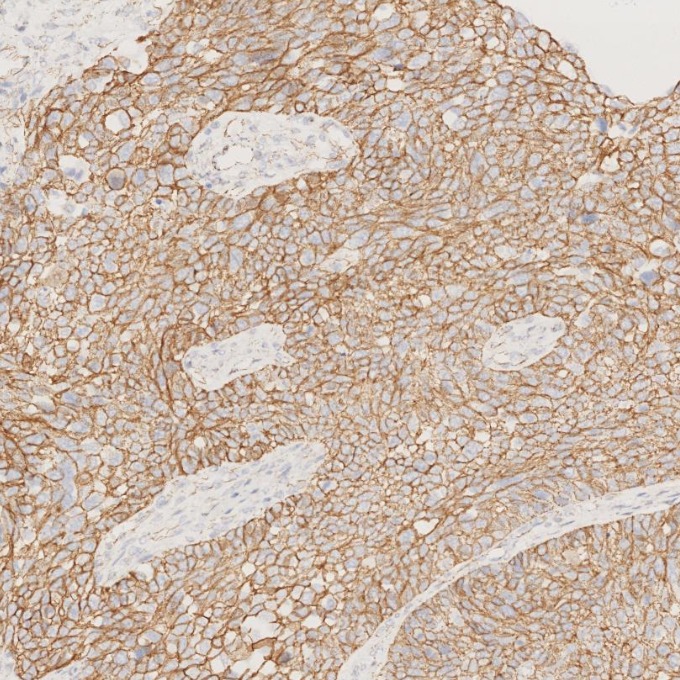 IHC staining of human ovary cancer using 66208-1-Ig IHC staining of human ovary cancer using 66208-1-Ig