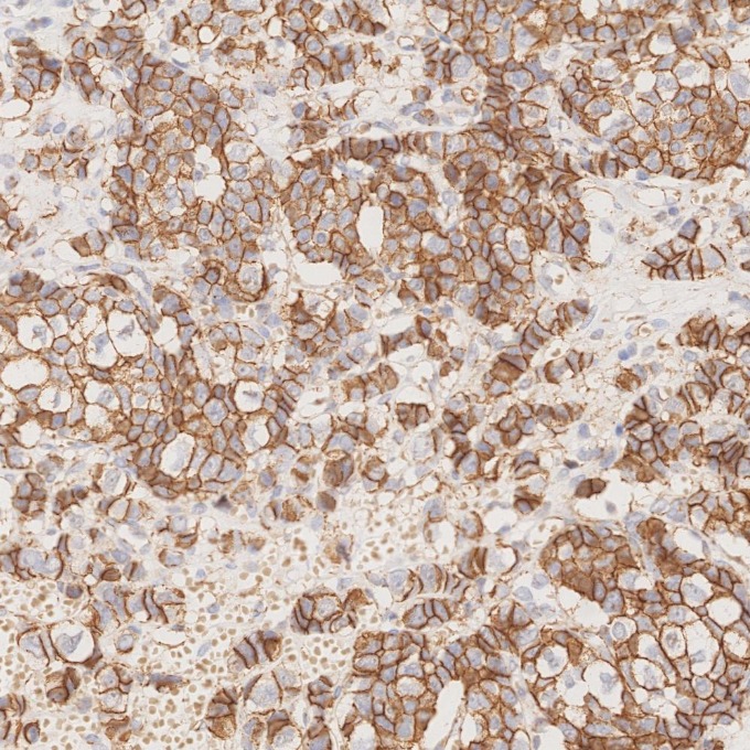 IHC staining of human breast cancer using 66208-1-Ig IHC staining of human breast cancer using 66208-1-Ig