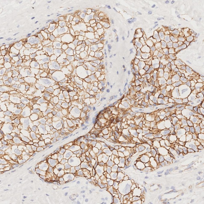 IHC staining of human breast cancer using 66208-1-Ig IHC staining of human breast cancer using 66208-1-Ig