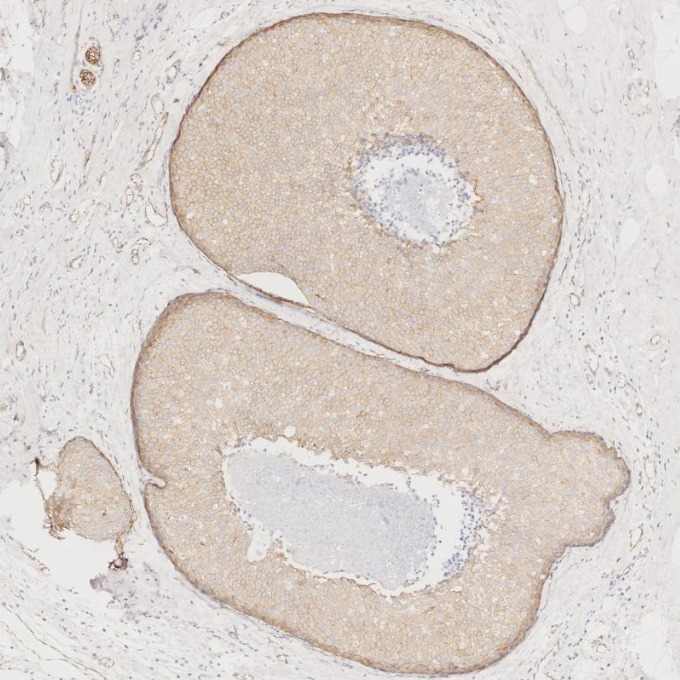 IHC staining of human breast cancer using 66208-1-Ig IHC staining of human breast cancer using 66208-1-Ig