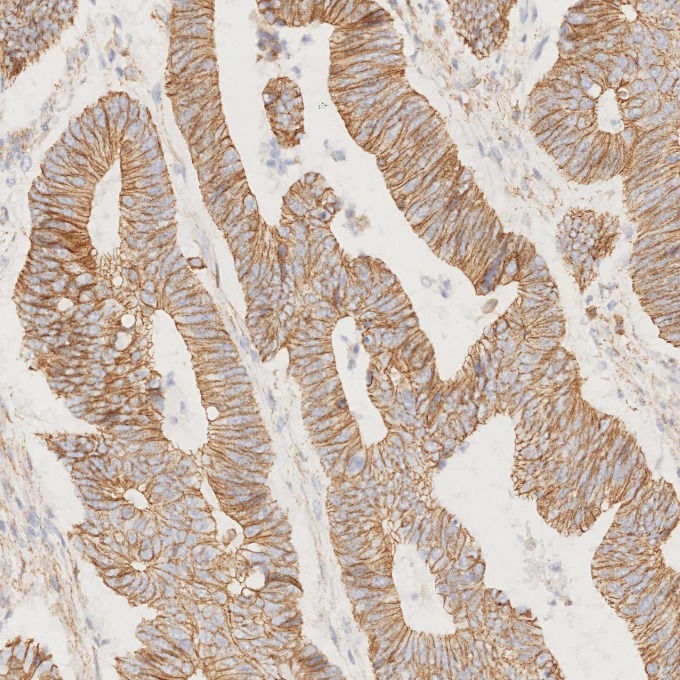 IHC staining of human colorectal cancer using 66208-1-Ig IHC staining of human colorectal cancer using 66208-1-Ig