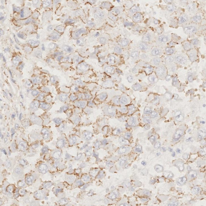 IHC staining of human stomach cancer using 66208-1-Ig IHC staining of human stomach cancer using 66208-1-Ig