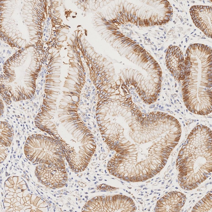 IHC staining of human stomach cancer using 66208-1-Ig IHC staining of human stomach cancer using 66208-1-Ig