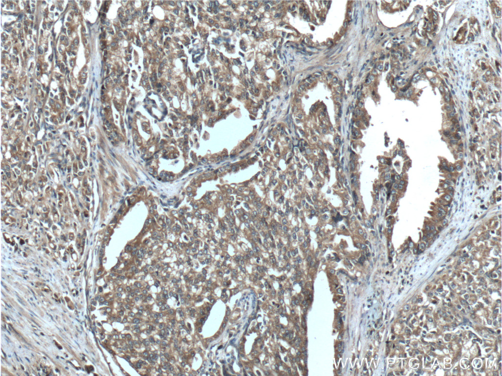 IHC staining of human prostate cancer using 12852-1-AP