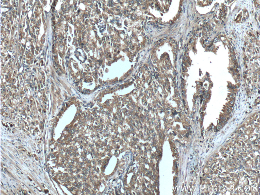 IHC staining of human prostate cancer using 12852-1-AP