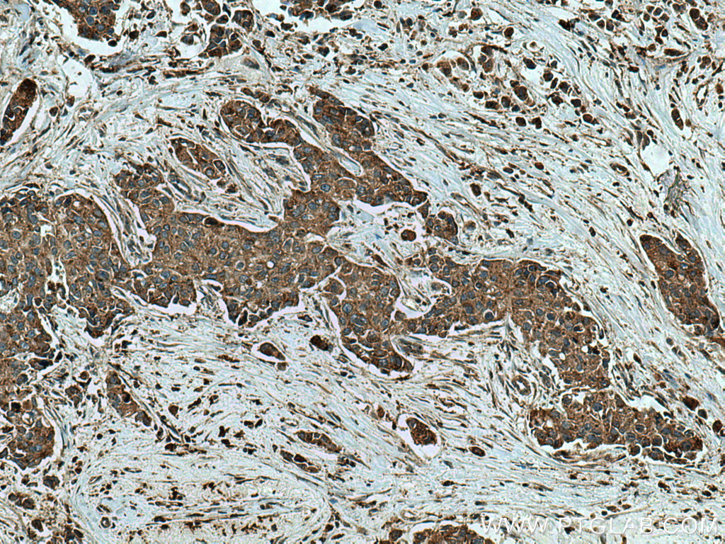 IHC staining of human breast cancer using 15020-1-AP