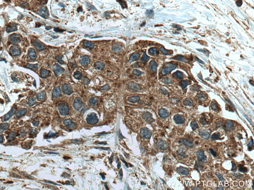 IHC staining of human breast cancer using 15020-1-AP