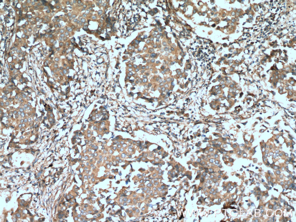 IHC staining of human breast cancer using 11239-1-AP