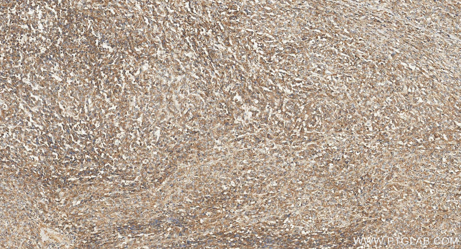 IHC staining of human malignant melanoma using 11239-1-AP IHC staining of human malignant melanoma using 11239-1-AP