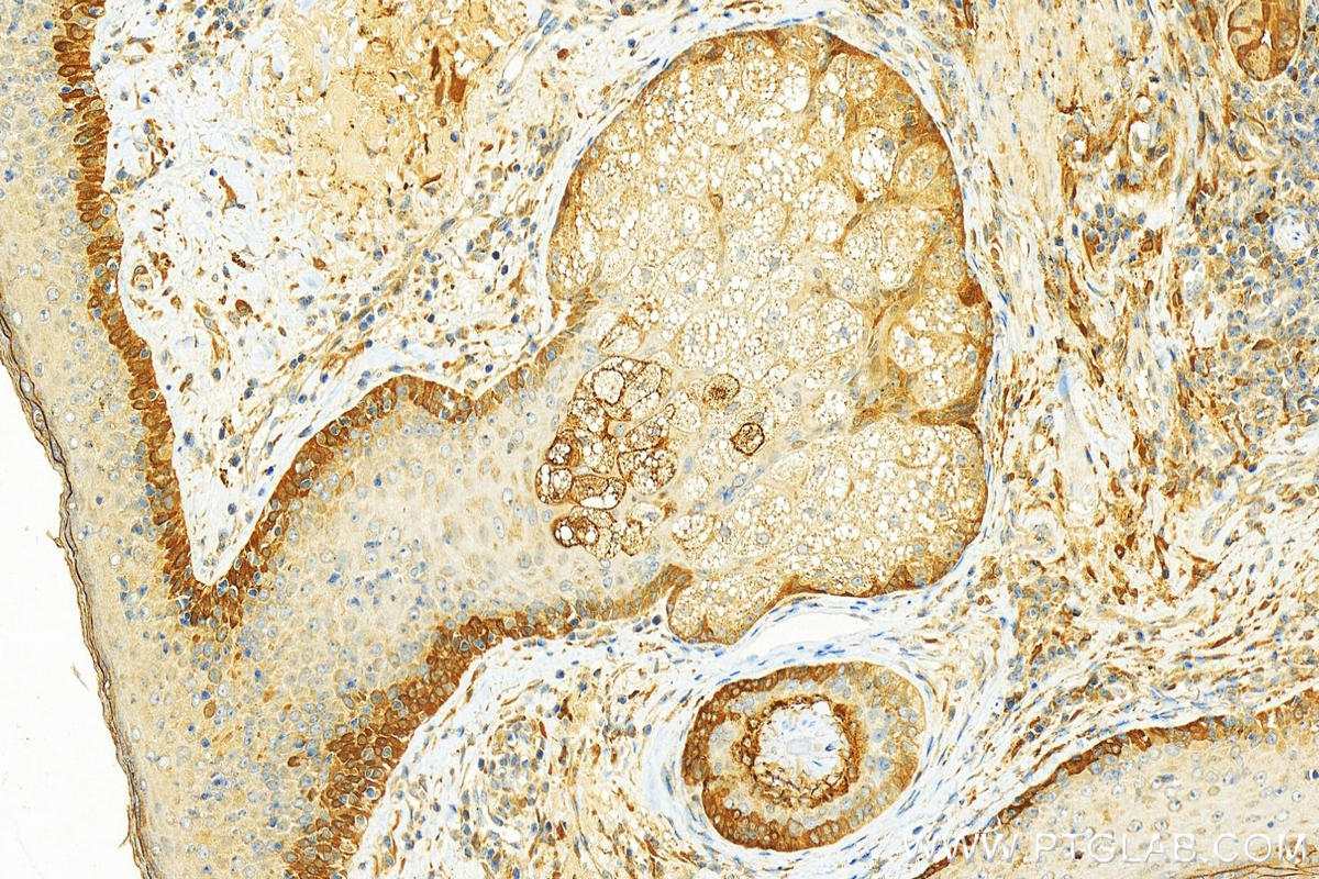 IHC staining of human skin cancer using 18442-1-AP